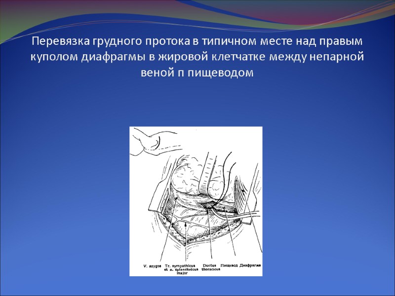 Перевязка грудного протока в типичном месте над правым куполом диафрагмы в жировой клетчатке между